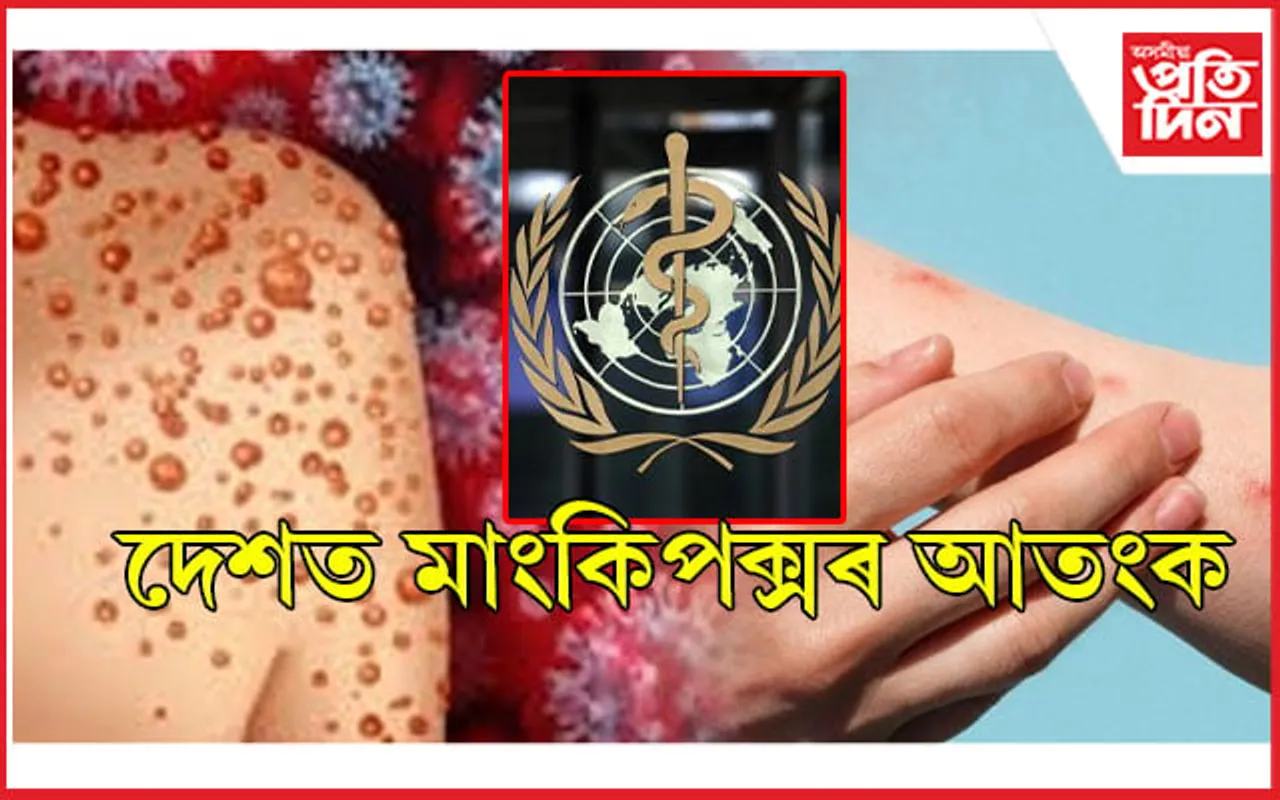 সাৱধান: ভাৰতত প্ৰথমজন মাংকিপক্স ৰোগী চিনাক্ত